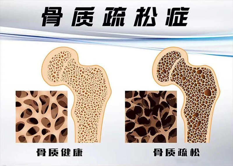 骨質疏松.jpg